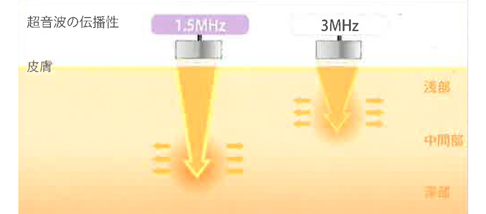 深部から浅部まで適切に対応する　1.5MHz・3MHzプローブ